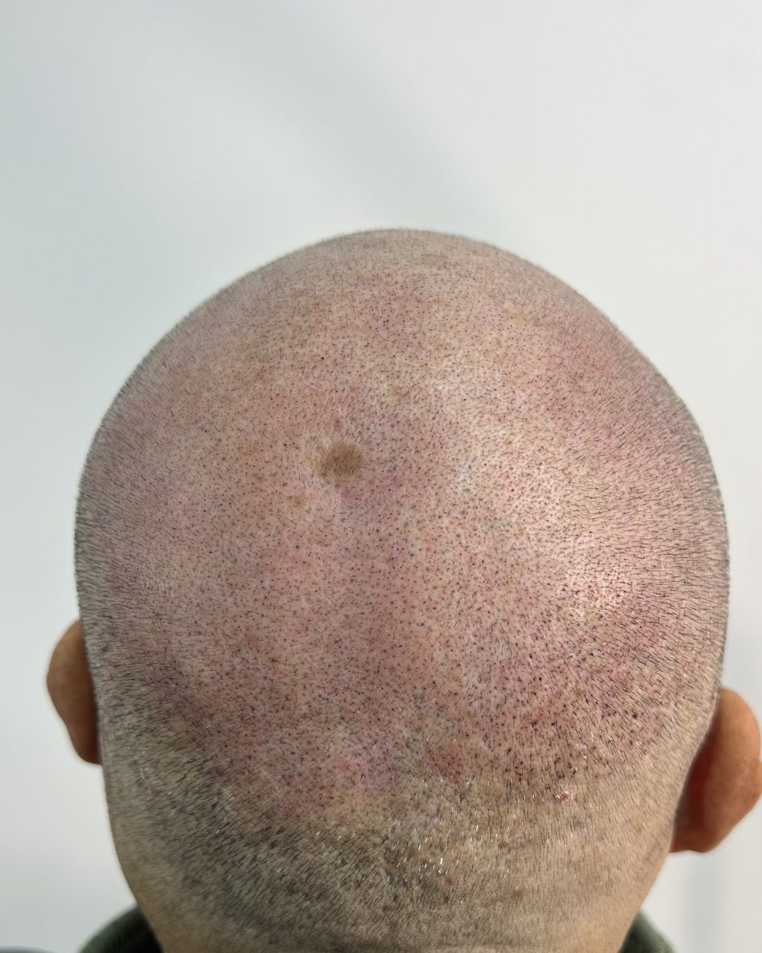 La nuca de un cliente, de espaldas, con la micropigmentación
               ya hecha: el pelo rapado y la zona sin pelo tienen la misma
               densidad